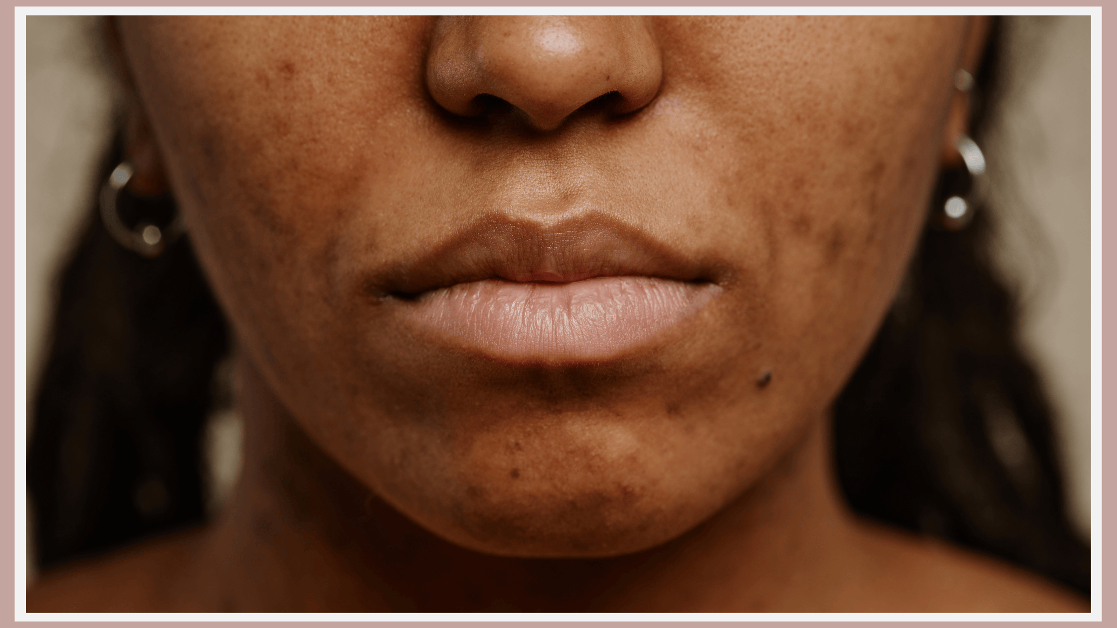Dark Spots Taneet Clinic